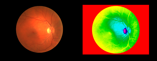 Human retina normal and false colored by R. Berdan ©