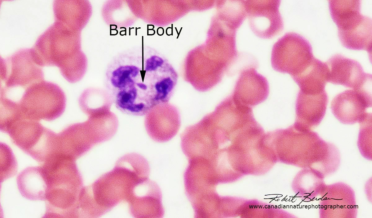 Blood smear showing a neutrophil with a Barr body Robert Berdan ©